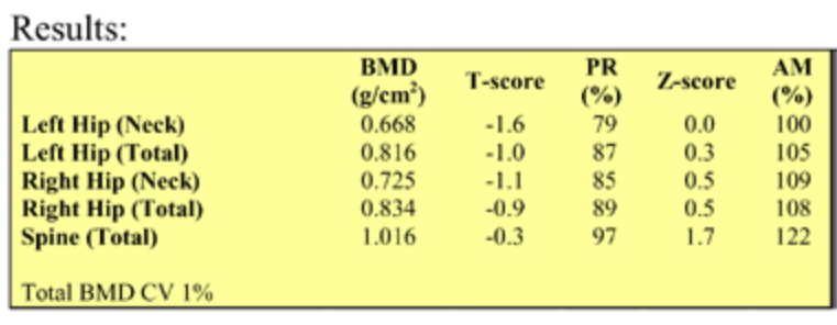 BMD scan sample report with both T-scores & Z-scores